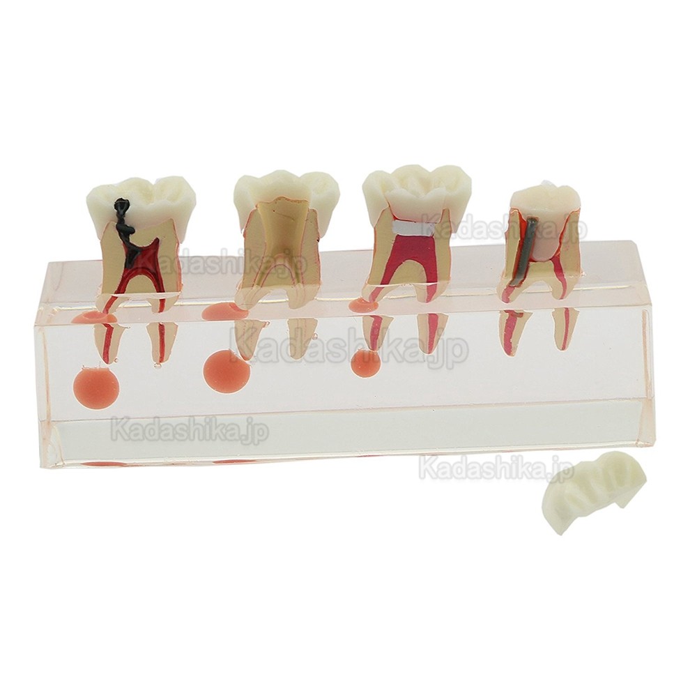 歯科透明歯髄疾患処置説明用模型 虫歯歯髄炎治療模型
