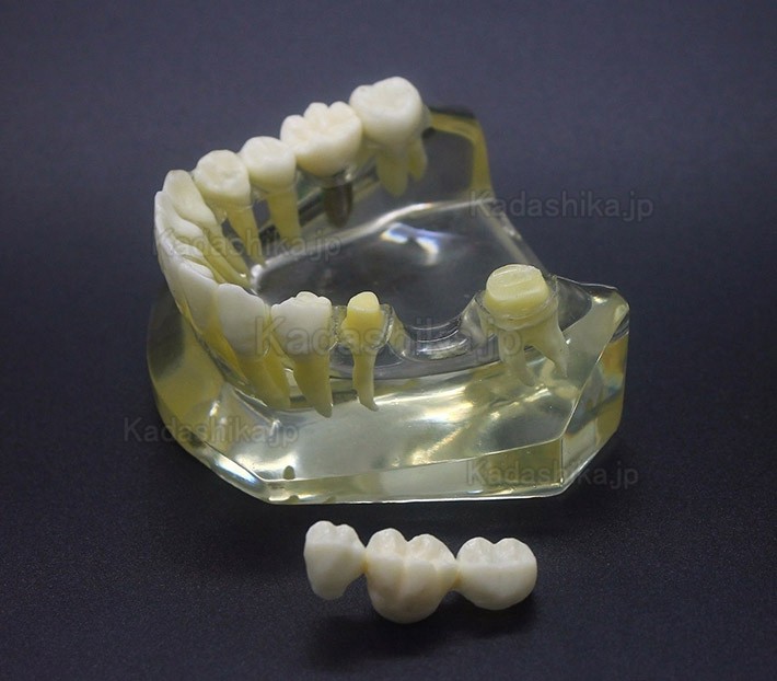 歯科インプラント説明用模型 (インプラントとブリッジの違い説明)