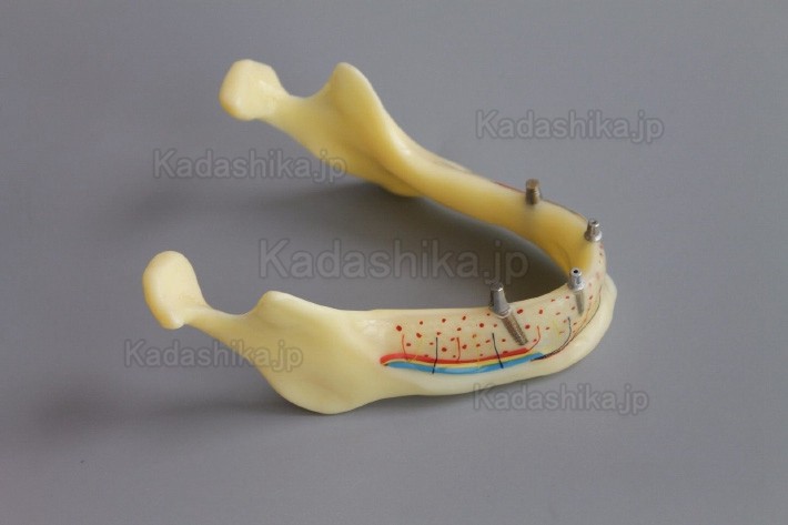 下顎骨組織とインプラント模型 + オーバーデンチャーモデル ＃2014 02