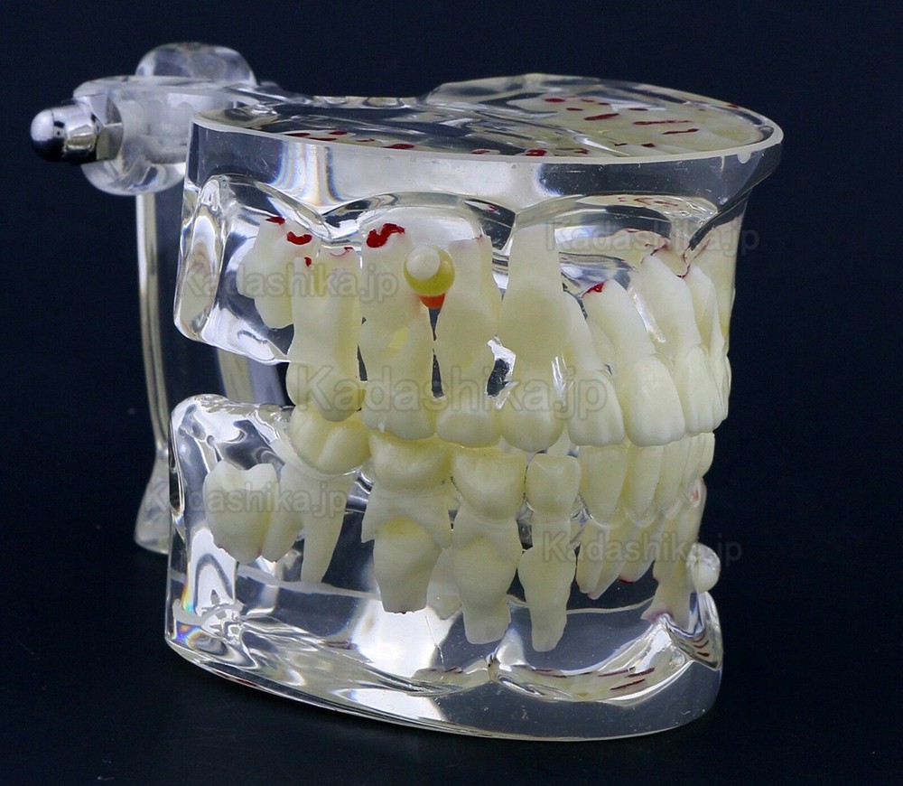 透明乳歯疾患模型 子供小児歯科病理模型 #4002