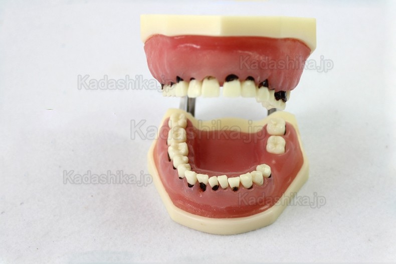 ENOVO® 歯科重度歯周病説明用顎模型